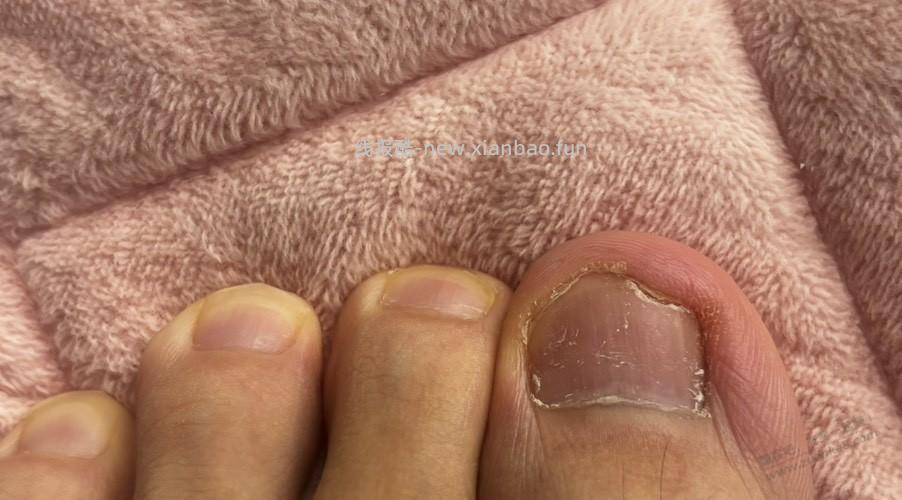 给大家推荐一个灰指甲的药吧，便宜，有用，亲测 - 线报酷