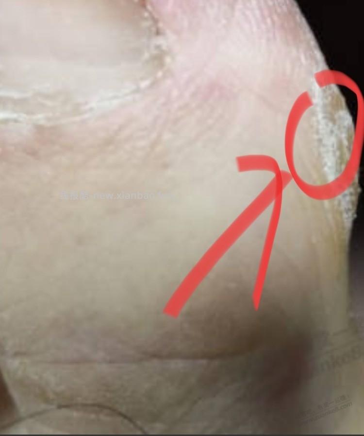 给大家推荐一个灰指甲的药吧，便宜，有用，亲测 - 线报酷