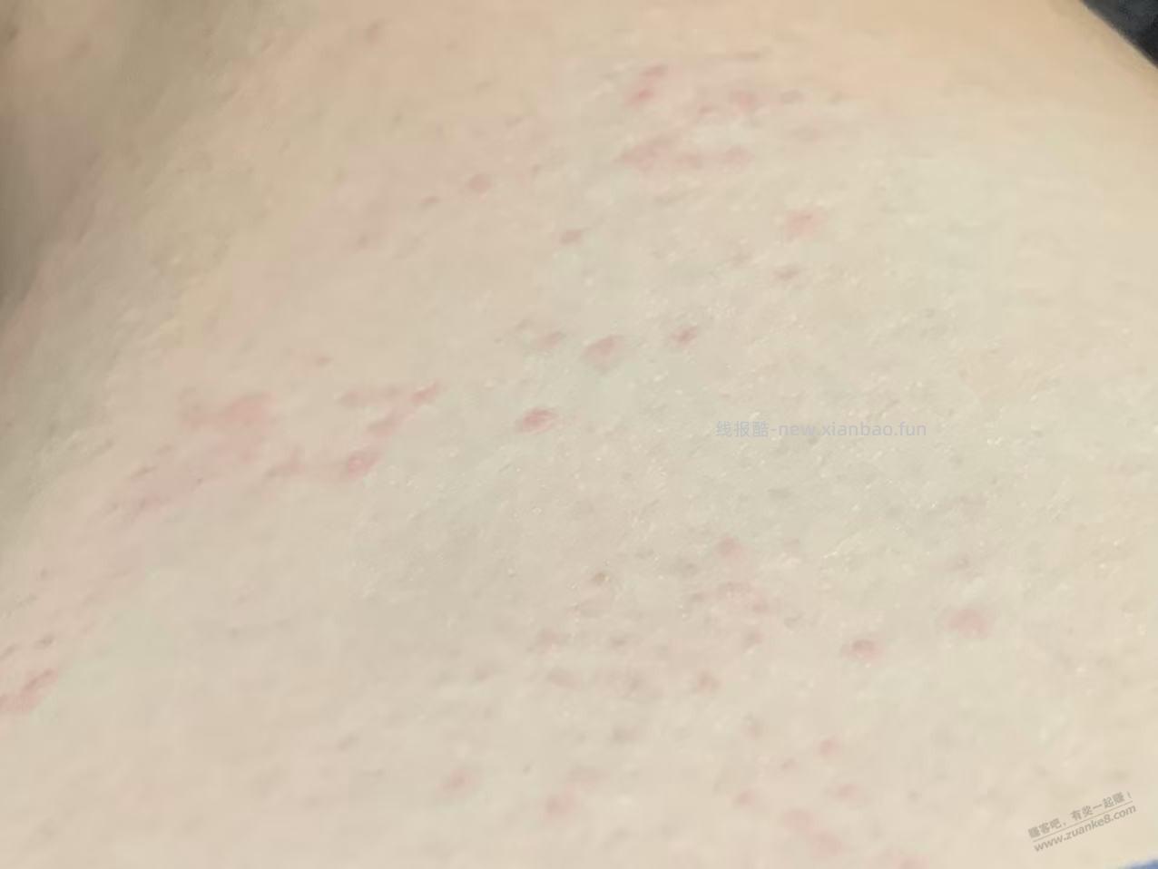 内侧长满小红点