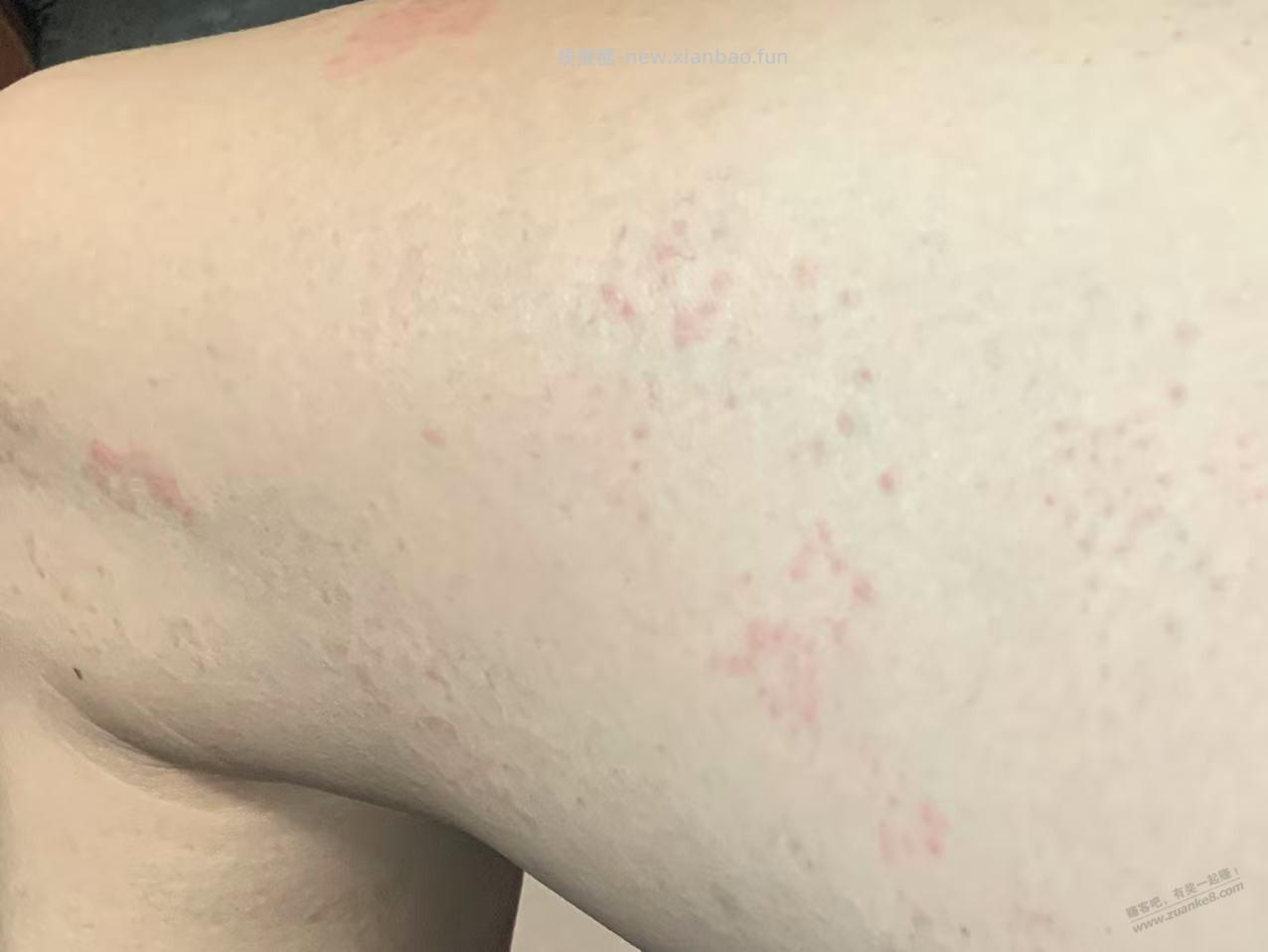 内侧长满小红点