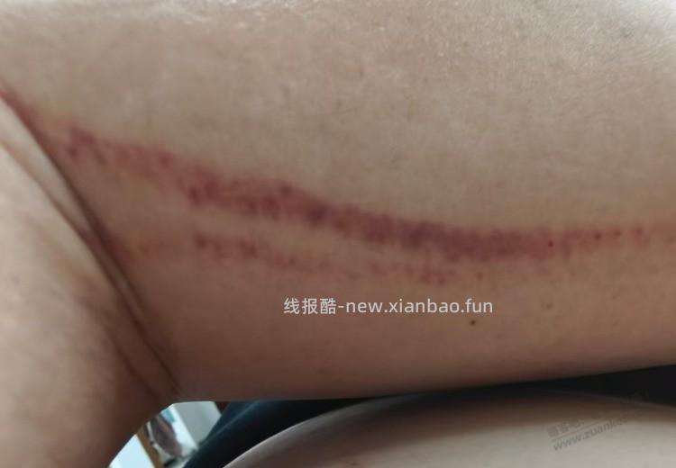 结婚六年了 ，被家暴了十多次，今天我终于还手，把我对象打了，我忍了六年了 - 线报酷