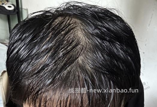 日记：唉，秃头了，附照片（不喜勿进） - 线报酷