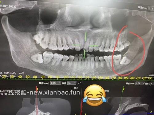 拔牙后几天真难熬 阻生智齿 帮助大家下次搜索有数据 - 线报酷