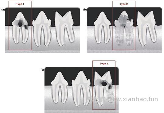 【科普】[养猫笔记05-医疗] 猫牙破齿细胞吸收性损伤（FORL）— 猫第二大常见疾病 - 线报酷